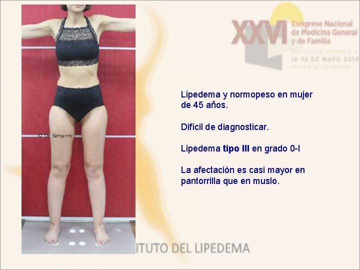 Lipedema y normopeso en mujer de 45 años. Difícil de diagnosticar. Lipedema tipo III