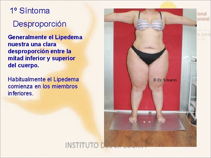 1º Síntoma Desproporción Generalmente el Lipedema nuestra una clara desproporción entre la mitad inferior