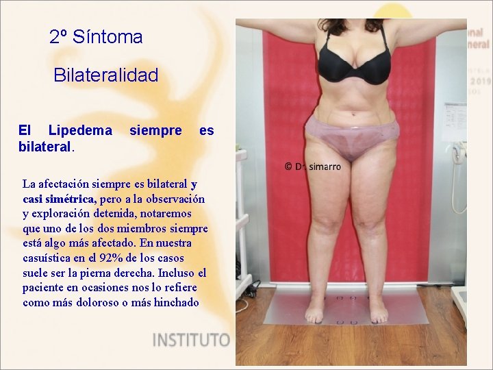 2º Síntoma Bilateralidad El Lipedema bilateral. siempre es La afectación siempre es bilateral y