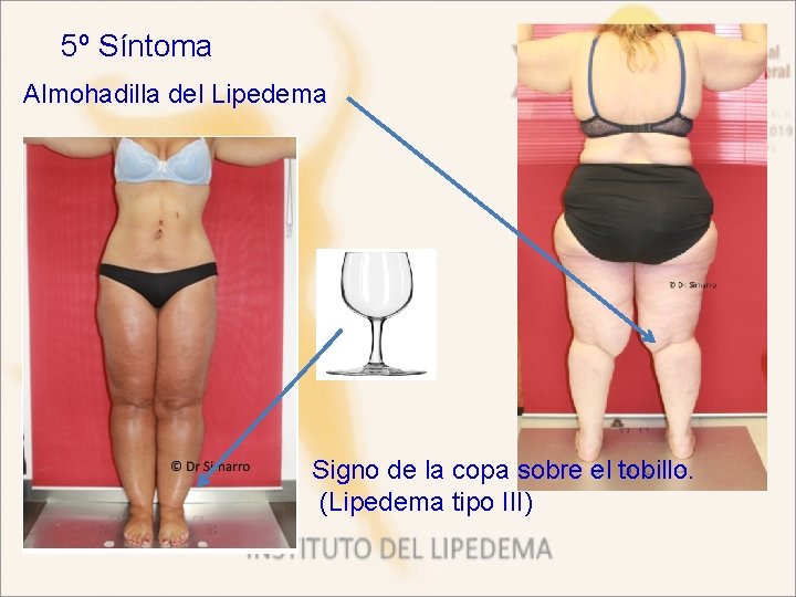 5º Síntoma Almohadilla del Lipedema Signo de la copa sobre el tobillo. (Lipedema tipo