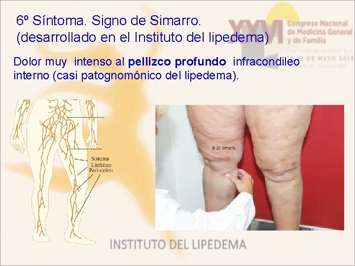 6º Síntoma. Signo de Simarro. (desarrollado en el Instituto del lipedema) Dolor muy intenso