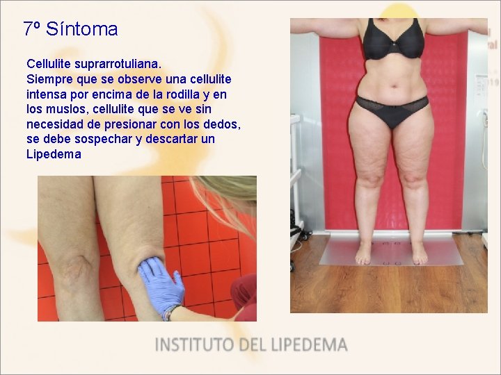 7º Síntoma Cellulite suprarrotuliana. Siempre que se observe una cellulite intensa por encima de