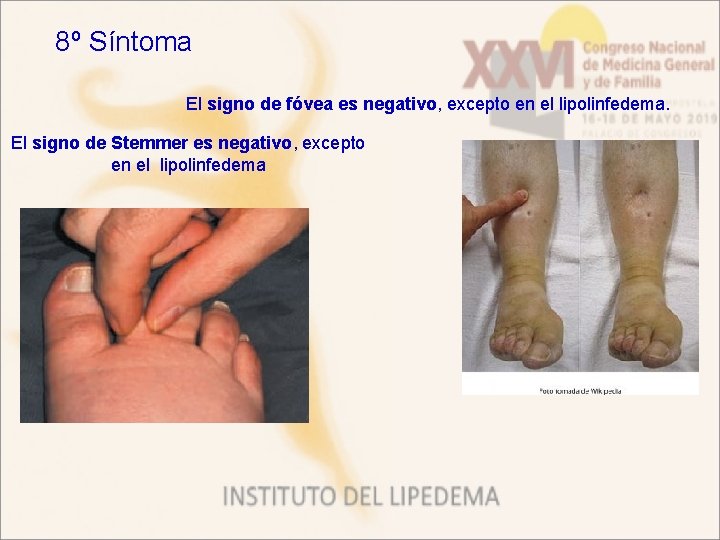 8º Síntoma El signo de fóvea es negativo, excepto en el lipolinfedema. El signo