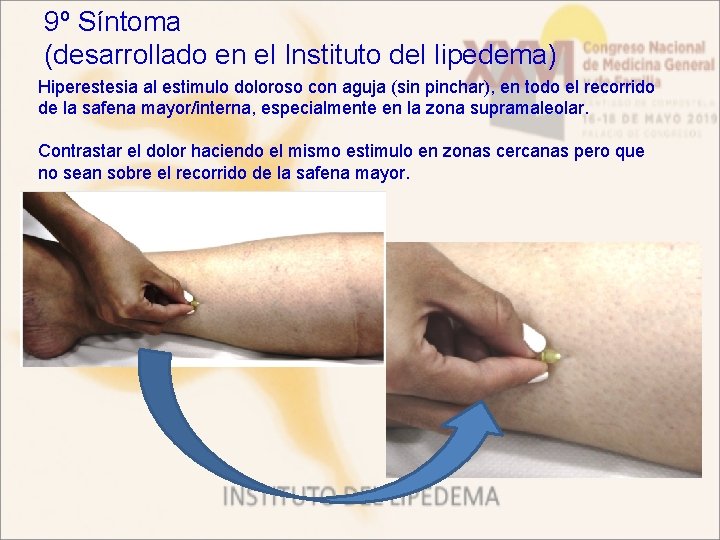 9º Síntoma (desarrollado en el Instituto del lipedema) Hiperestesia al estimulo doloroso con aguja
