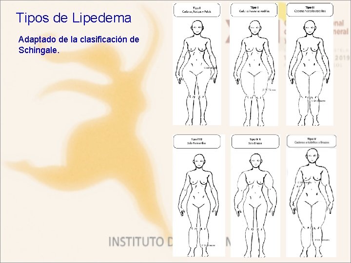 Tipos de Lipedema Adaptado de la clasificación de Schingale. 