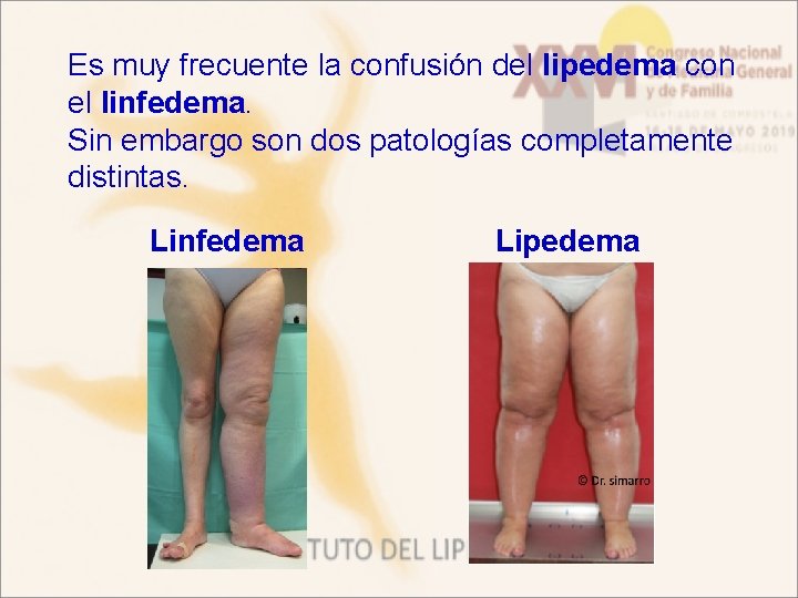 Es muy frecuente la confusión del lipedema con el linfedema. Sin embargo son dos