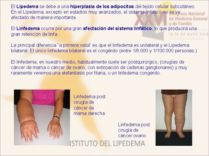 El Lipedema se debe a una hiperplasia de los adipocitos del tejido celular subcutáneo.