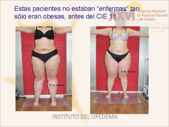 Estas pacientes no estaban “enfermas“ tan sólo eran obesas, antes del CIE 11 