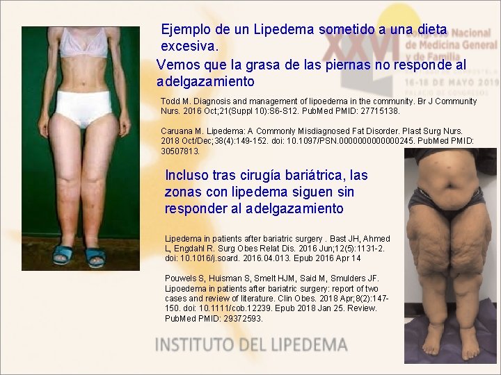 Ejemplo de un Lipedema sometido a una dieta excesiva. Vemos que la grasa de