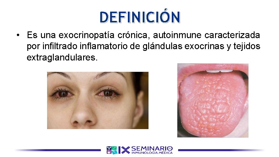 DEFINICIÓN • Es una exocrinopatía crónica, autoinmune caracterizada por infiltrado inflamatorio de glándulas exocrinas