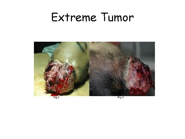 Extreme Tumor 