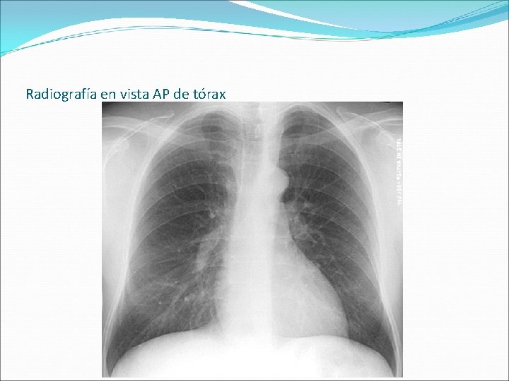 Radiografía en vista AP de tórax 