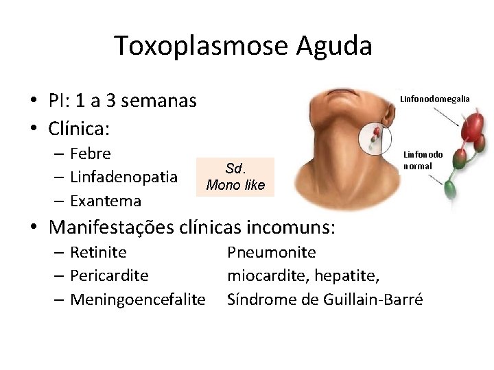 Toxoplasmose Aguda • PI: 1 a 3 semanas • Clínica: – Febre – Linfadenopatia