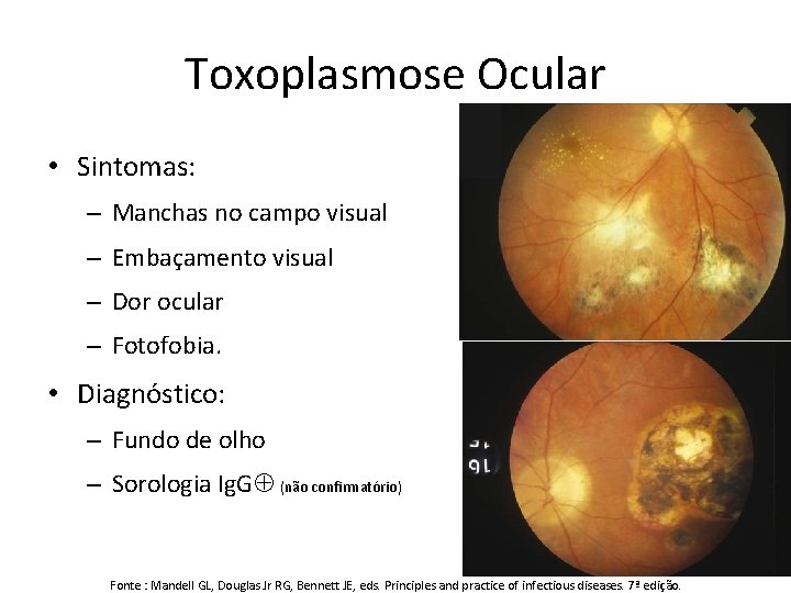 Toxoplasmose Ocular • Sintomas: – Manchas no campo visual – Embaçamento visual – Dor