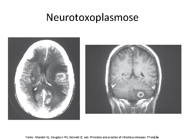 Neurotoxoplasmose Fonte : Mandell GL, Douglas Jr RG, Bennett JE, eds. Principles and practice