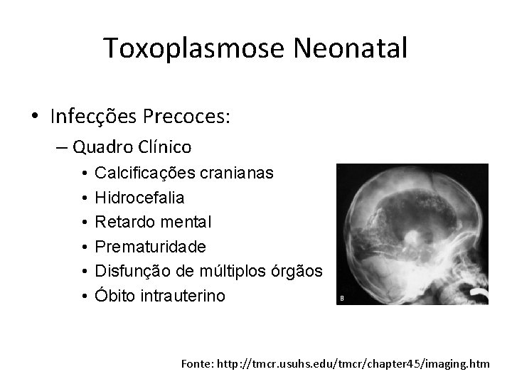 Toxoplasmose Neonatal • Infecções Precoces: – Quadro Clínico • • • Calcificações cranianas Hidrocefalia