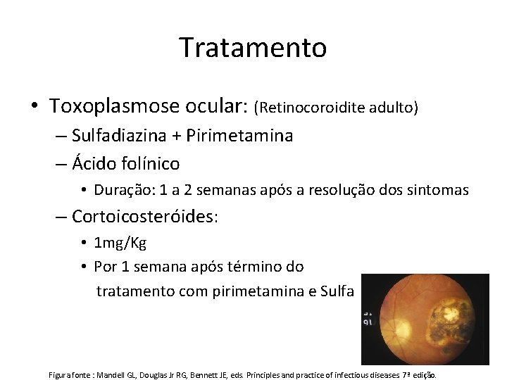 Tratamento • Toxoplasmose ocular: (Retinocoroidite adulto) – Sulfadiazina + Pirimetamina – Ácido folínico •