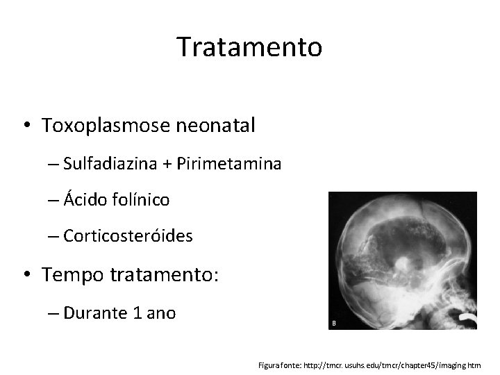 Tratamento • Toxoplasmose neonatal – Sulfadiazina + Pirimetamina – Ácido folínico – Corticosteróides •