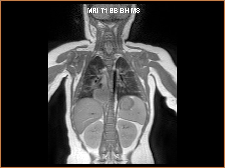 MRI T 1 BB BH MS 