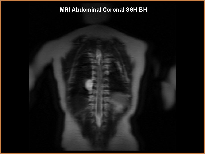 MRI Abdominal Coronal SSH BH 