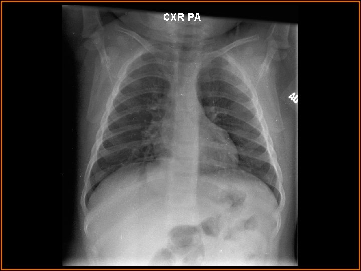 CXR PA 