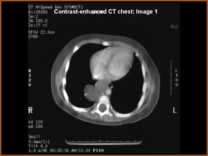 Contrast-enhanced CT chest: Image 1 