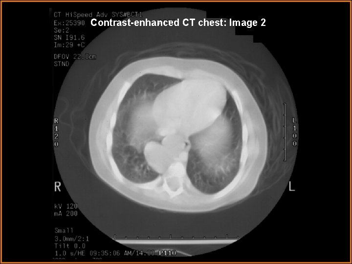 Contrast-enhanced CT chest: Image 2 Contrast-enhanced CT chest: Image 2