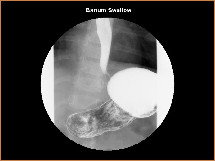 Barium Swallow 