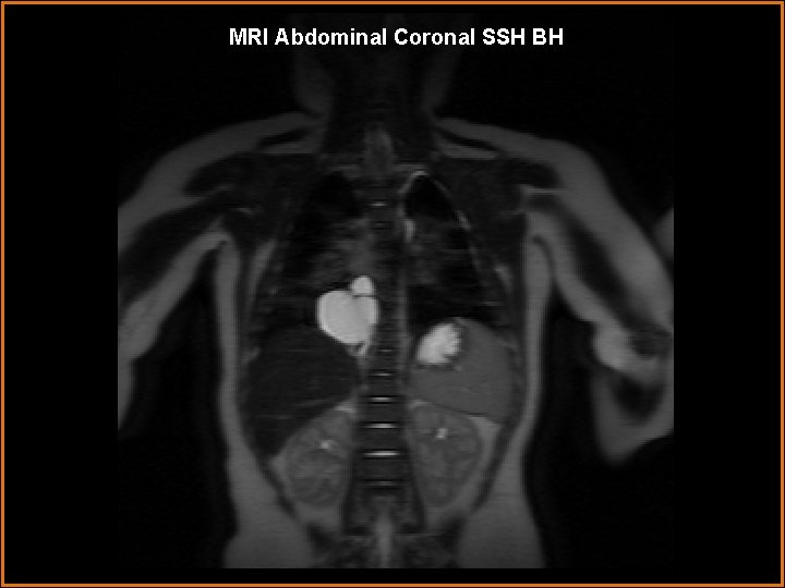 MRI Abdominal Coronal SSH BH 