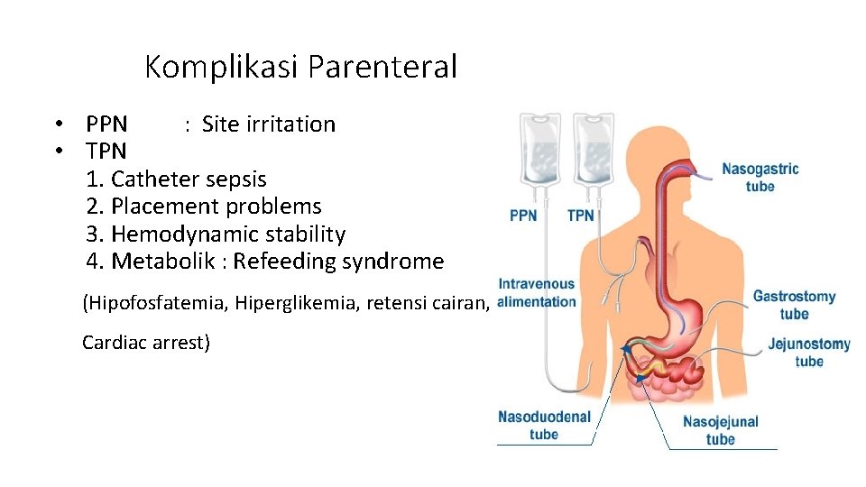 Komplikasi Parenteral • PPN : Site irritation • TPN 1. Catheter sepsis 2. Placement Komplikasi Parenteral • PPN : Site irritation • TPN 1. Catheter sepsis 2. Placement