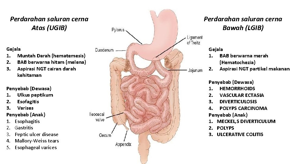 Perdarahan saluran cerna Atas (UGIB) Gejala 1. Muntah Darah (hematemesis) 2. BAB berwarna hitam Perdarahan saluran cerna Atas (UGIB) Gejala 1. Muntah Darah (hematemesis) 2. BAB berwarna hitam
