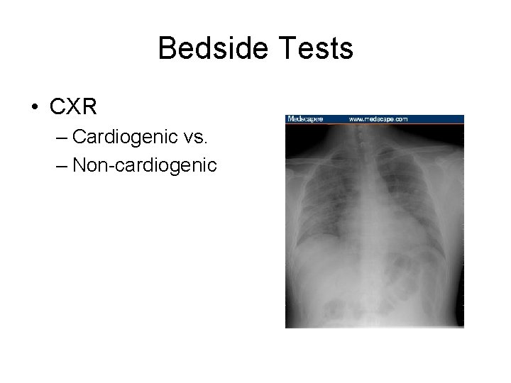 Bedside Tests • CXR – Cardiogenic vs. – Non-cardiogenic 