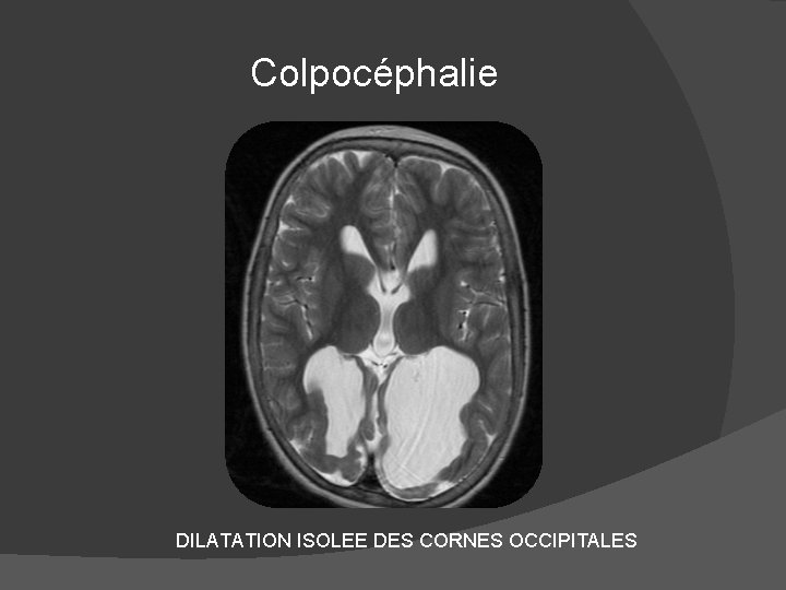 Colpocéphalie DILATATION ISOLEE DES CORNES OCCIPITALES 
