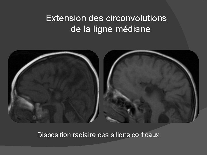 Extension des circonvolutions de la ligne médiane Disposition radiaire des sillons corticaux 
