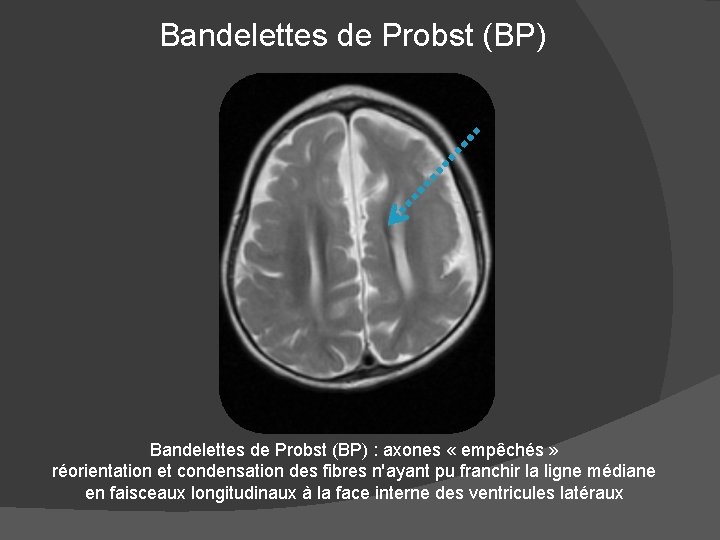 Bandelettes de Probst (BP) : axones « empêchés » réorientation et condensation des fibres