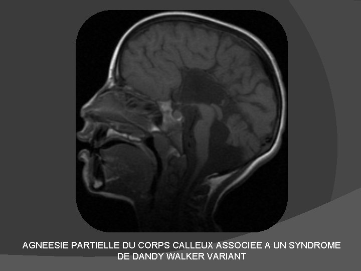 AGNEESIE PARTIELLE DU CORPS CALLEUX ASSOCIEE A UN SYNDROME DE DANDY WALKER VARIANT 