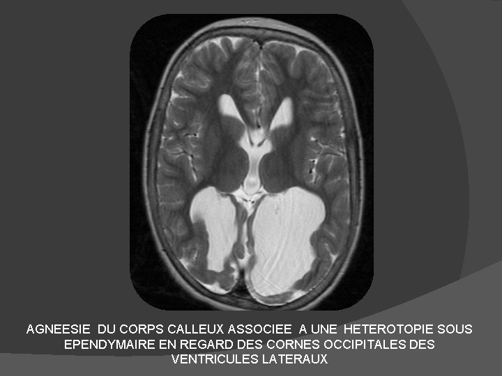 AGNEESIE DU CORPS CALLEUX ASSOCIEE A UNE HETEROTOPIE SOUS EPENDYMAIRE EN REGARD DES CORNES