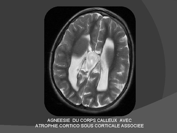 AGNEESIE DU CORPS CALLEUX AVEC ATROPHIE CORTICO SOUS CORTICALE ASSOCIEE 