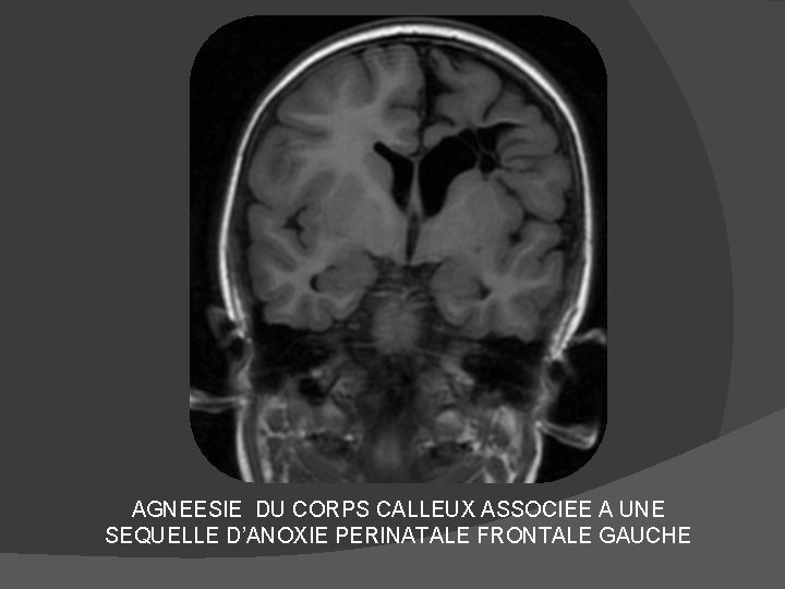 AGNEESIE DU CORPS CALLEUX ASSOCIEE A UNE SEQUELLE D’ANOXIE PERINATALE FRONTALE GAUCHE 