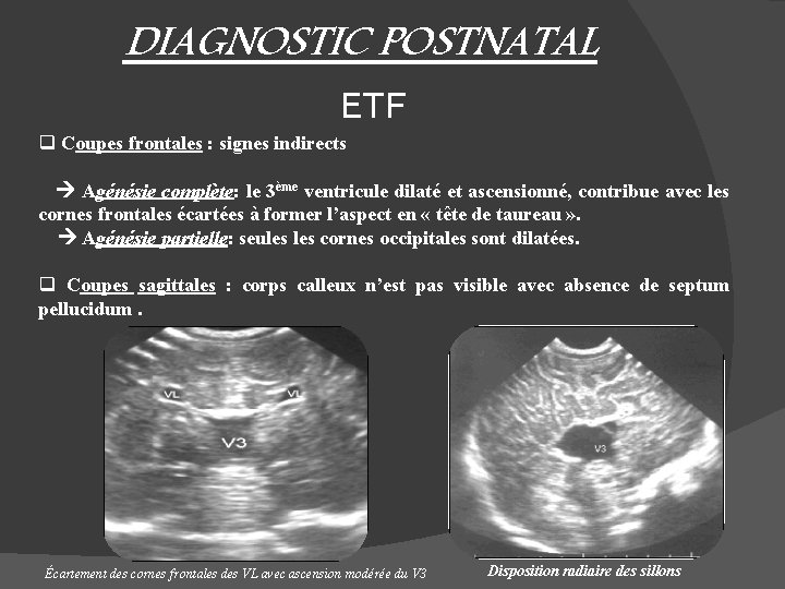 DIAGNOSTIC POSTNATAL ETF q Coupes frontales : signes indirects Agénésie complète: le 3ème ventricule
