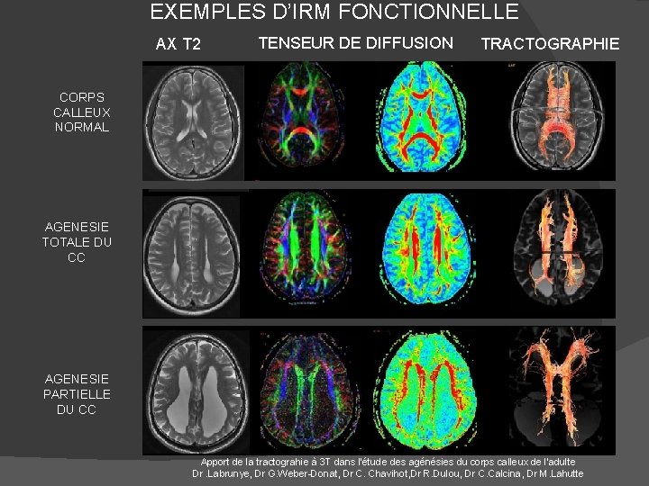 EXEMPLES D’IRM FONCTIONNELLE AX T 2 TENSEUR DE DIFFUSION TRACTOGRAPHIE CORPS CALLEUX NORMAL AGENESIE