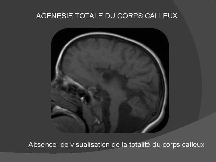  AGENESIE TOTALE DU CORPS CALLEUX Absence de visualisation de la totalité du corps