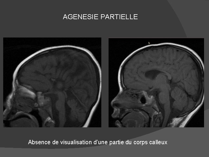 AGENESIE PARTIELLE Absence de visualisation d’une partie du corps calleux 