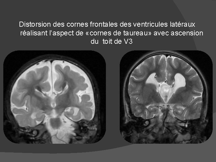 Distorsion des cornes frontales des ventricules latéraux réalisant l’aspect de «cornes de taureau» avec