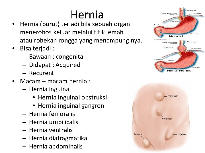Hernia • Hernia (burut) terjadi bila sebuah organ menerobos keluar melalui titik lemah atau