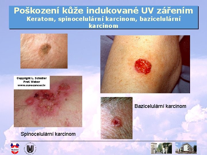 Poškození kůže indukované UV zářením Keratom, spinocelulární karcinom, bazicelulární karcinom Bazicelulární karcinom Spinocelulární karcinom