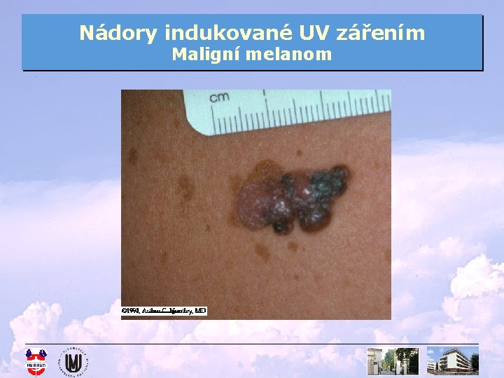 Nádory indukované UV zářením Maligní melanom 