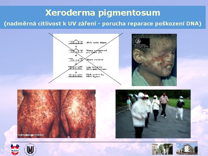 Xeroderma pigmentosum (nadměrná citlivost k UV záření - porucha reparace poškození DNA) 