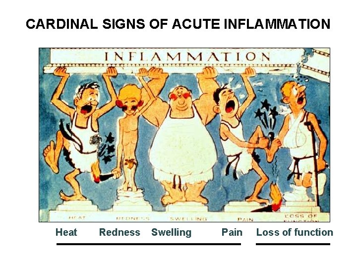 CARDINAL SIGNS OF ACUTE INFLAMMATION Heat Redness Swelling Pain Loss of function 