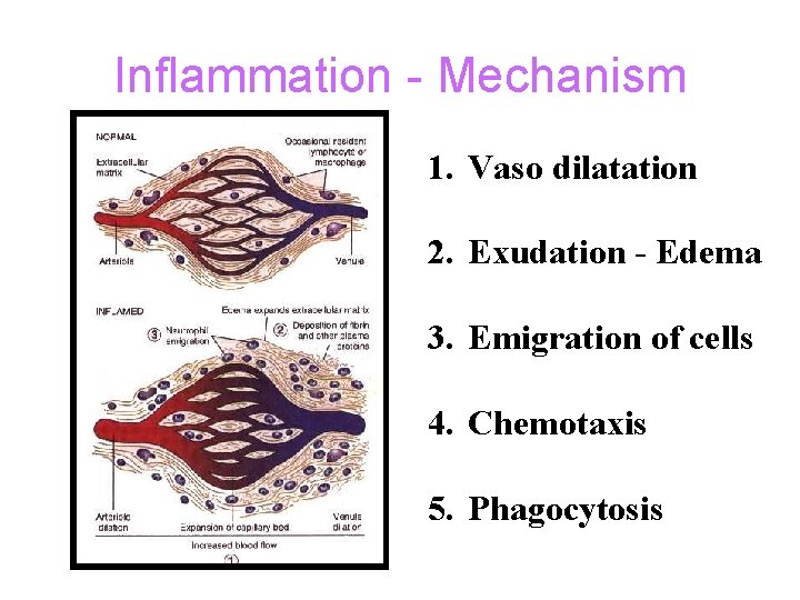 Inflammation - Mechanism 1. Vaso dilatation 2. Exudation - Edema 3. Emigration of cells